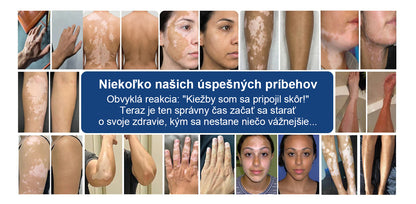 CleraNature® Piperine Repigment Aktivátor Sprej, ktorý aktivuje spiace pigmentové bunky a obnovuje prirodzenú farbu pleti.