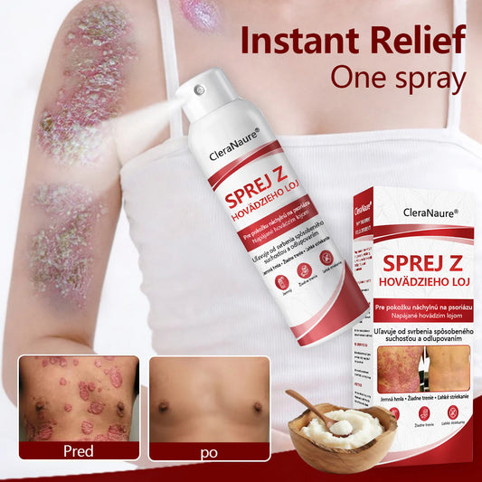 CleraNature® Beef Tallow Spray na svrbiacu, olupujúcu pokožku pri psoriáze