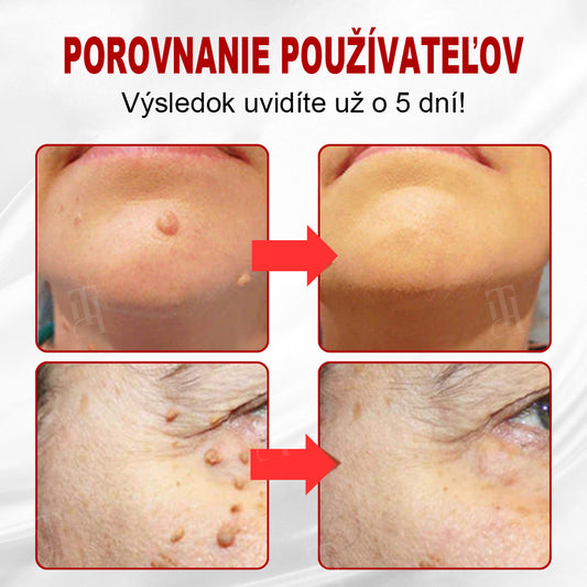 CleraNature® WartAway Pro náplasti