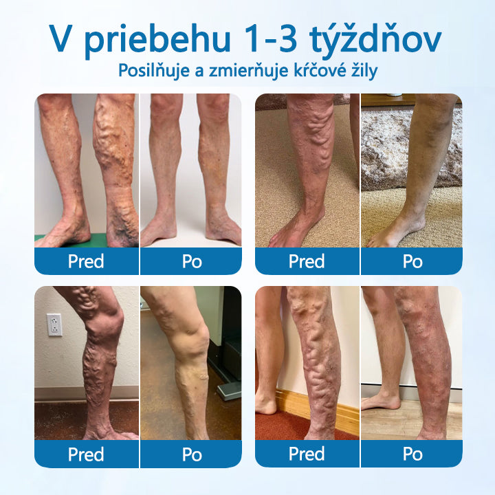 CleraNaure® VenGuard - Bylinný sprej na kŕčové žily