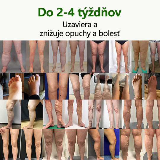 ✨Povedzte zbohom opuchnutým, boľavým nohám – CleraNaure® FluidEase Profesionálny krém na zlepšenie krvného obehu v nohách prináša skutočnú úľavu! ✨🦵