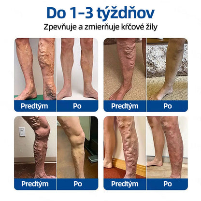 💙Healrize® VeinTarget mikrojihlová náplasť
