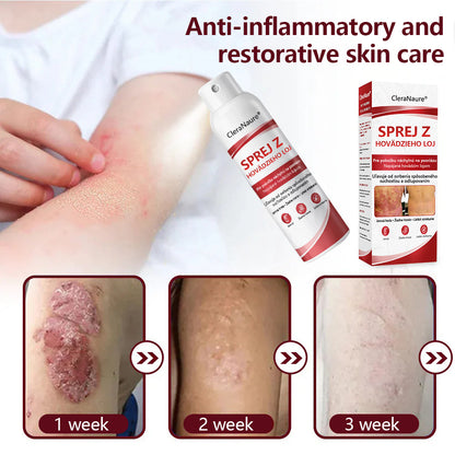 🥇CleraNature® Beef Tallow Spray na svrbiacu, olupujúcu pokožku pri psoriáze🥇