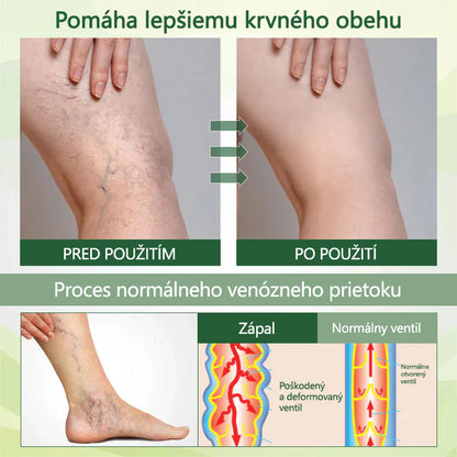 ✨Povedzte zbohom opuchnutým, boľavým nohám – CleraNaure® FluidEase Profesionálny krém na zlepšenie krvného obehu v nohách prináša skutočnú úľavu! ✨🦵