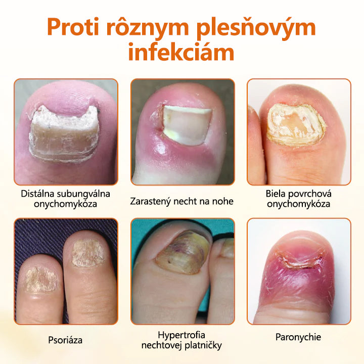 CleraNature® FungiBee Pokročilý sprej na opravu nechtov